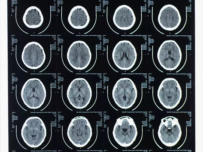 Brain scan